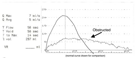 uroflow pvr|UROFLOW POST.